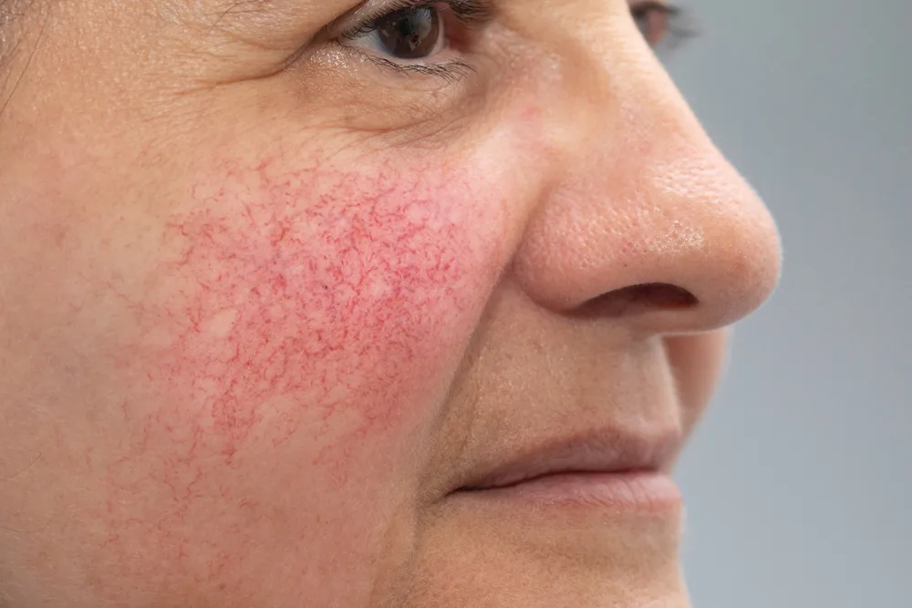 What to Do About Blotchy Skin on Face